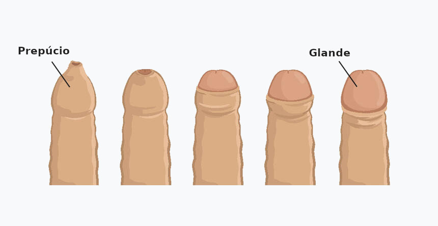 Ilustração anatômica do prepúcio e da glande na fimose